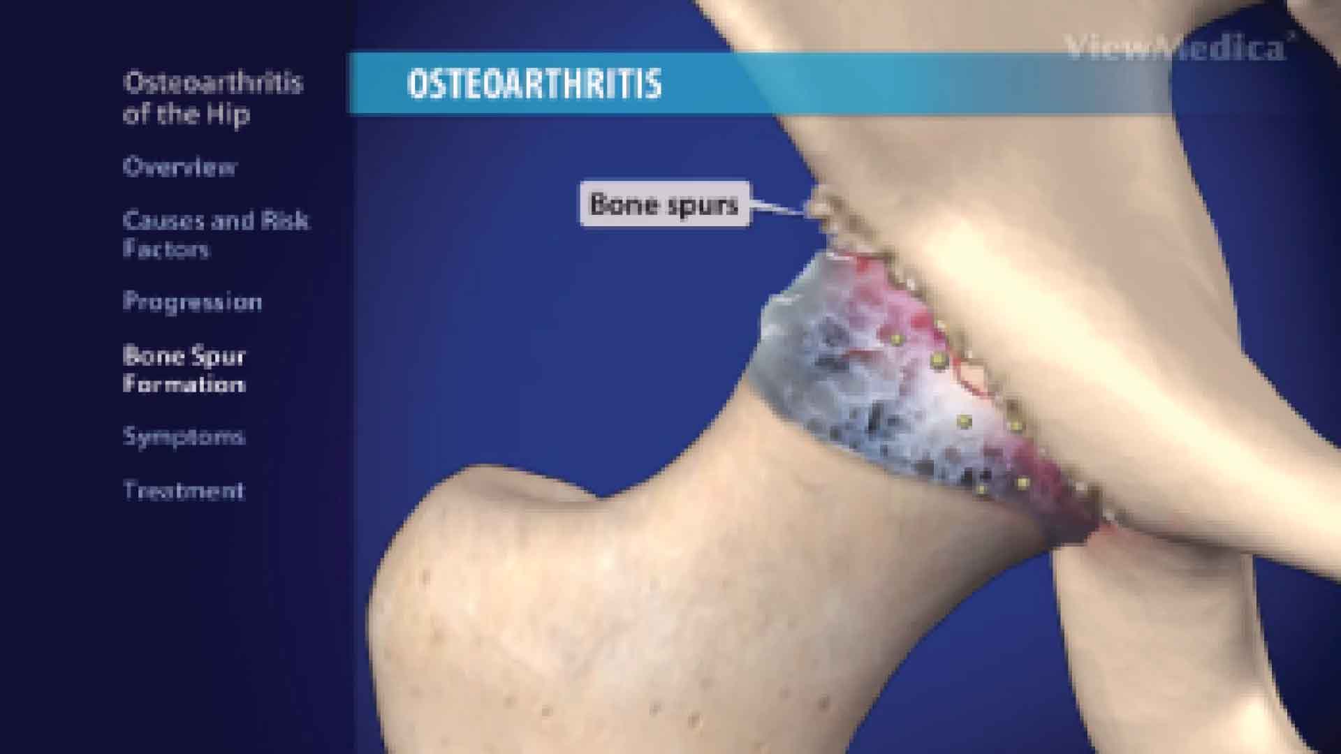 Hip arthritis