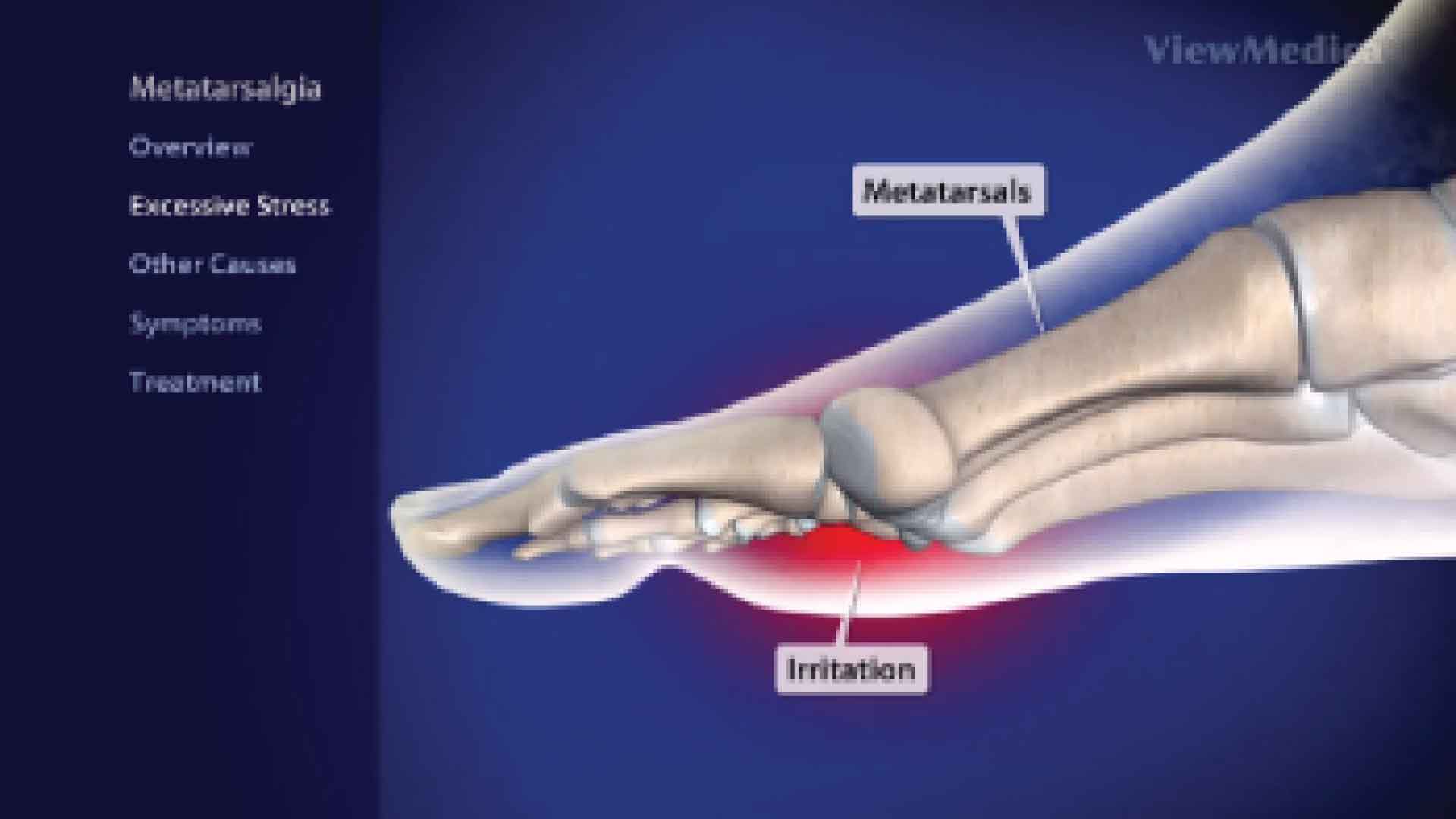 Metatarsalgia
