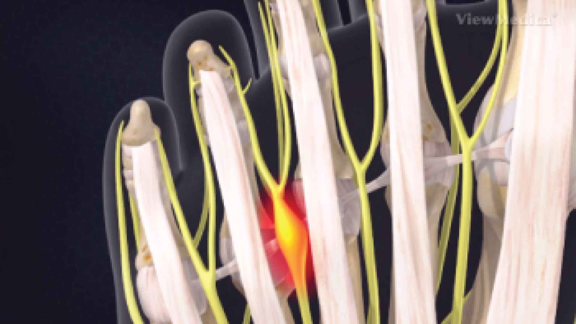 Morton's neuroma