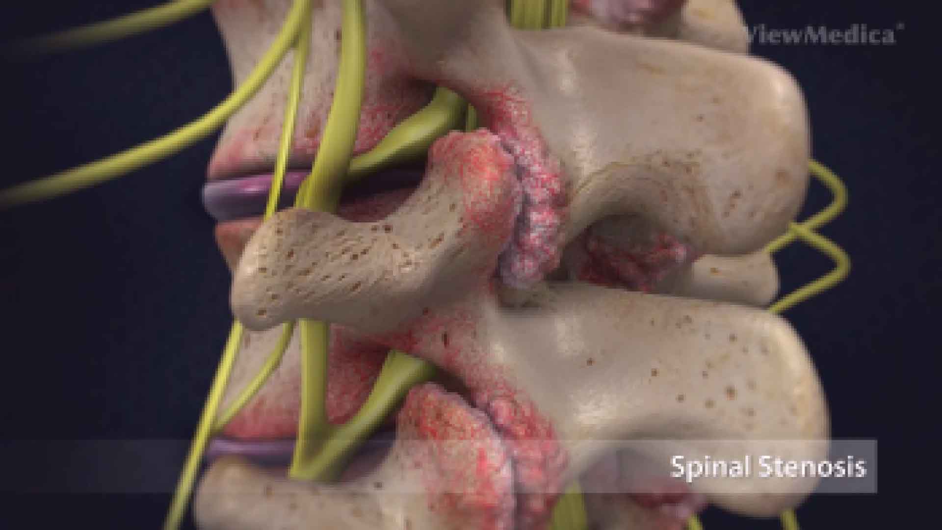 Sciatica