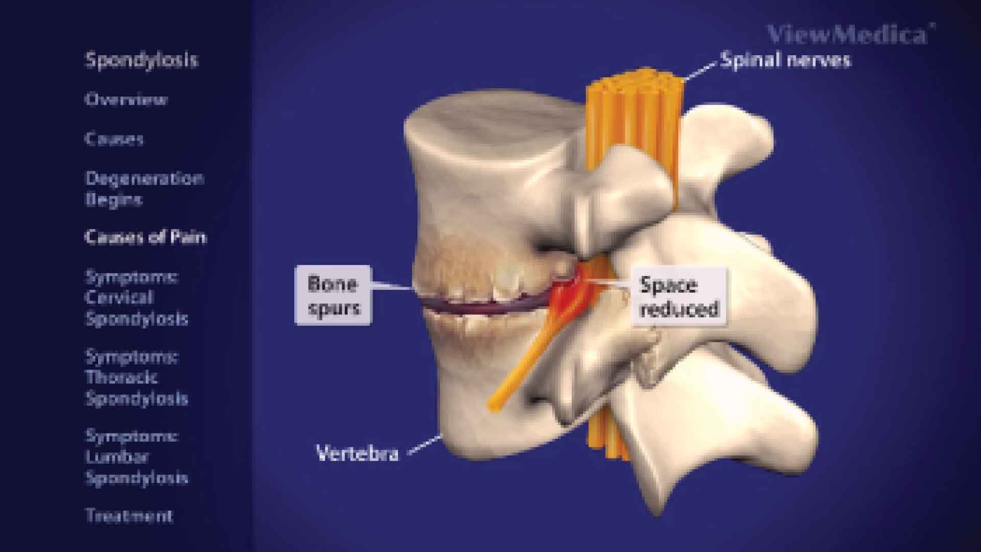 Spondylosis