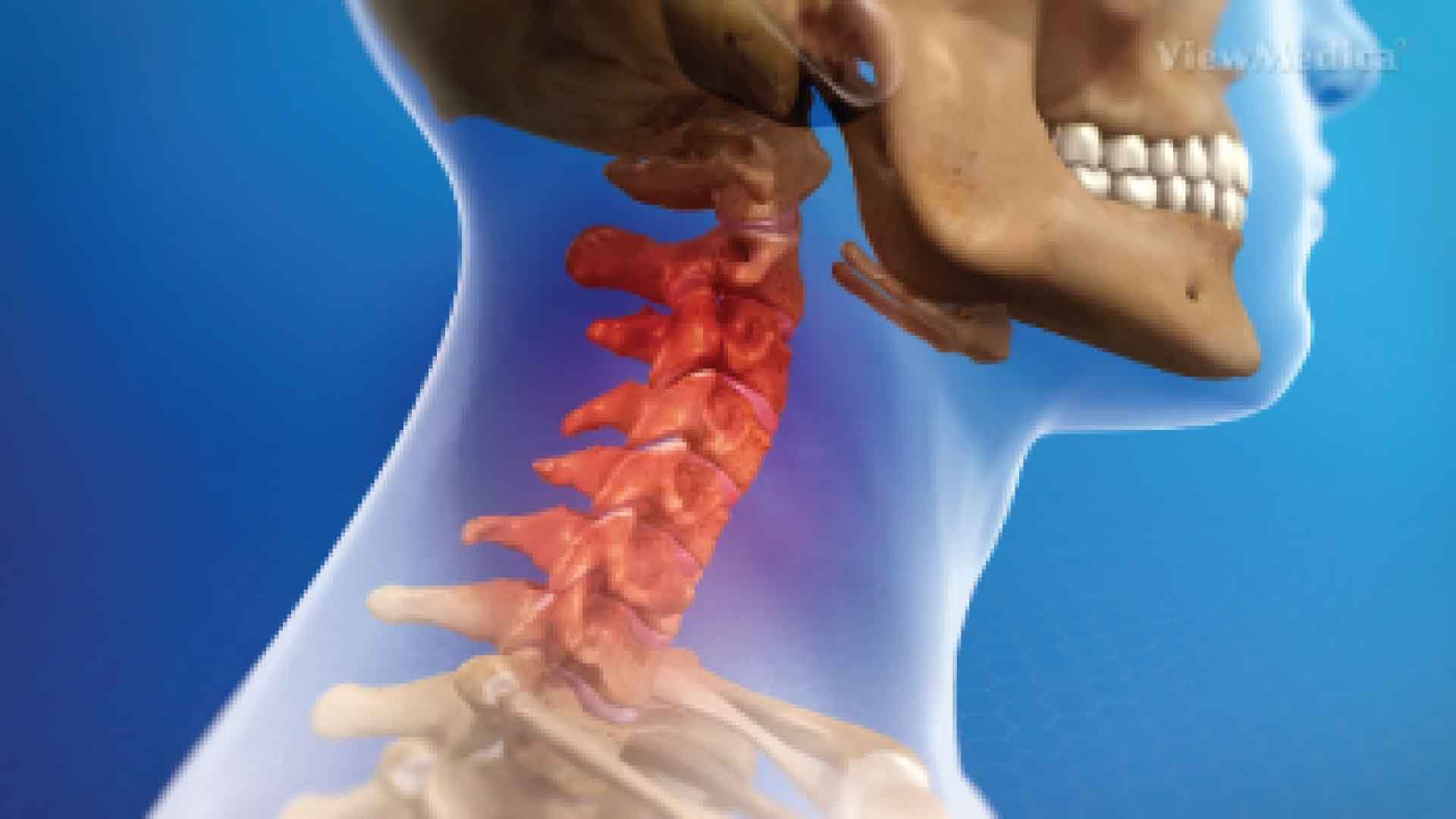 Whiplash syndrome