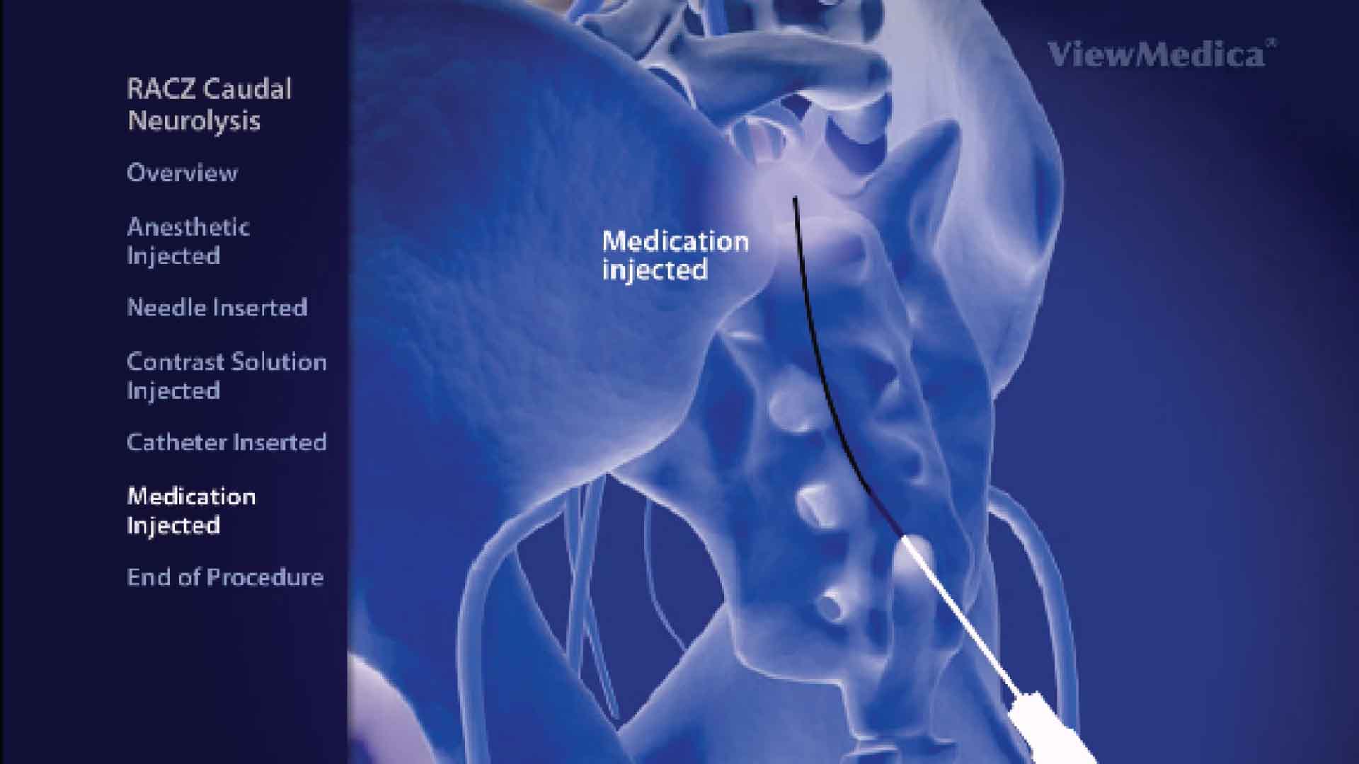 RACZ epidural