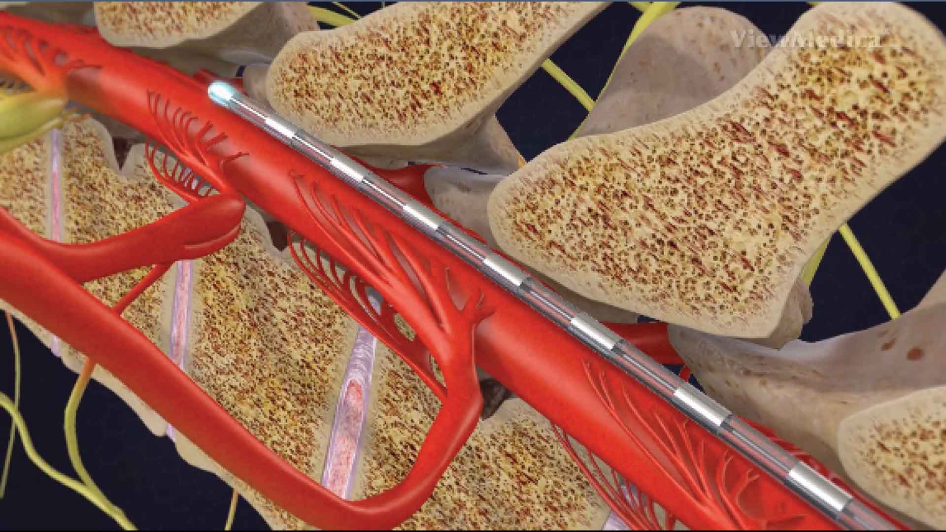 Epiduroscopy