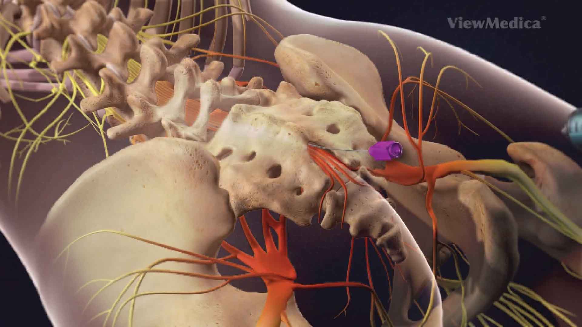 Caudal epidural