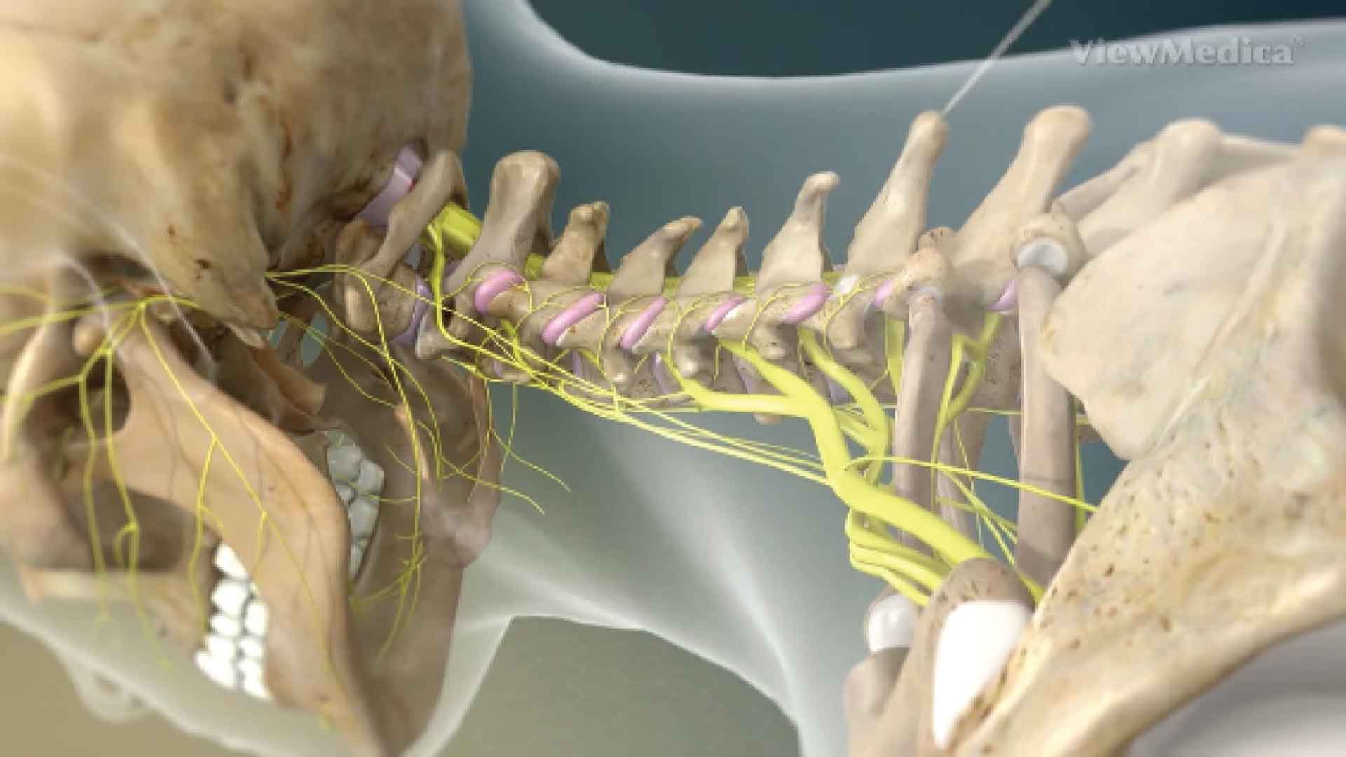 Cervical facet radiofrequency
