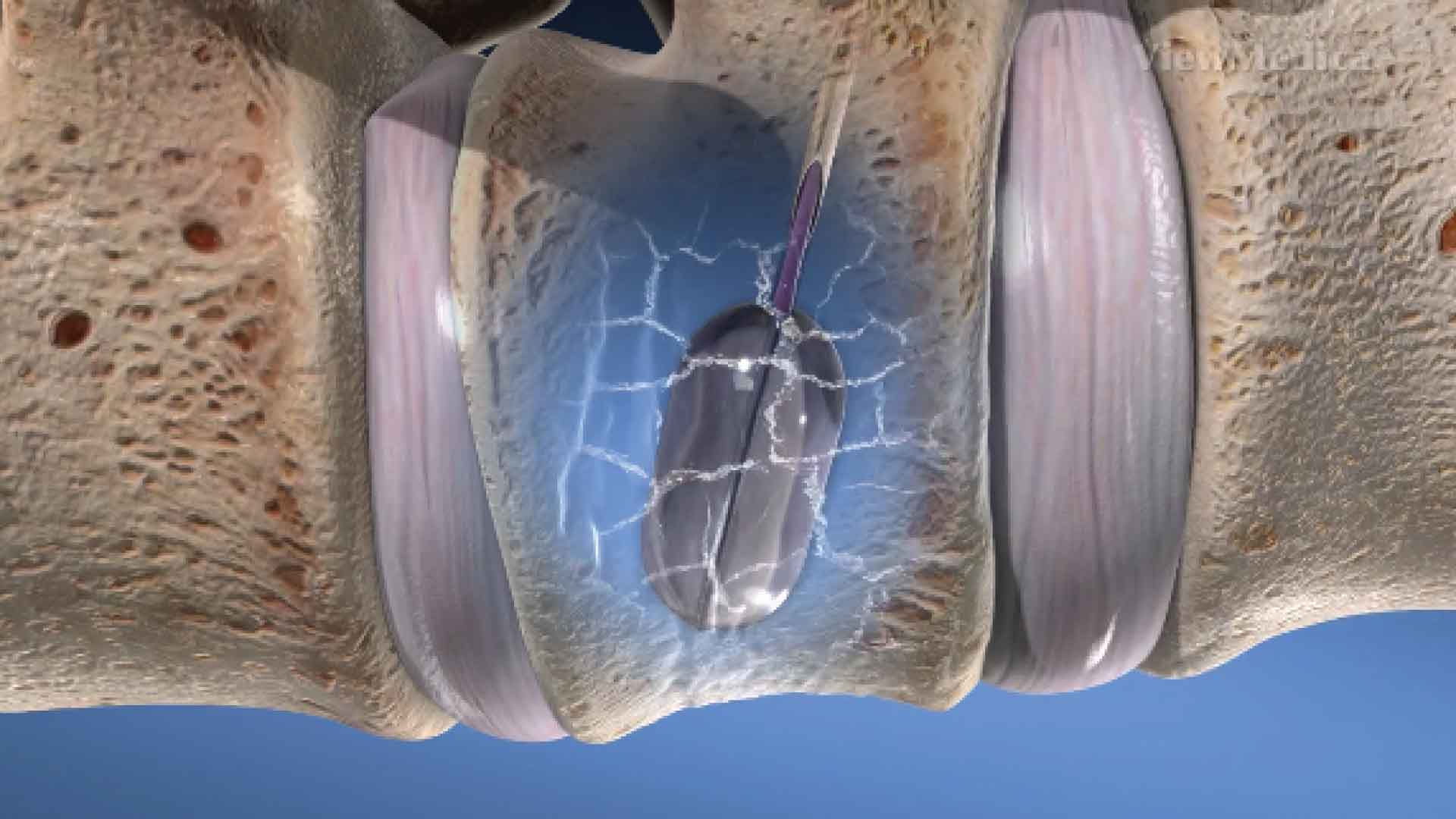 Kyphoplasty